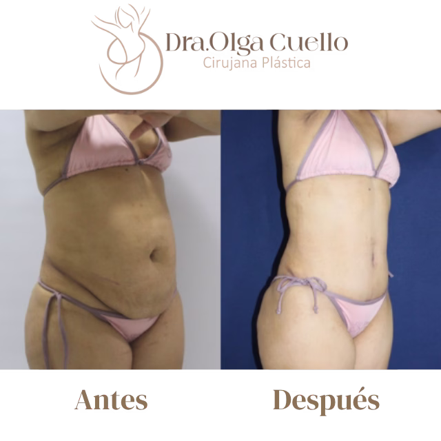 Candidatos ideales para abdominoplastia