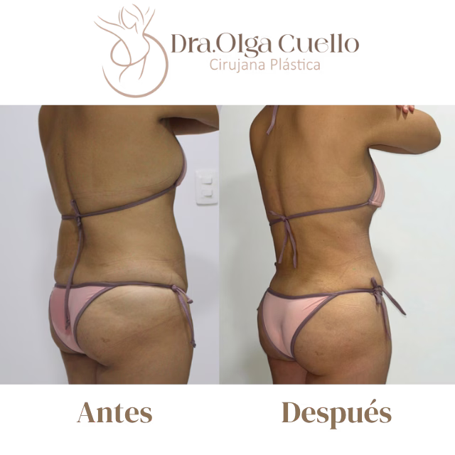 Caso real de abdominoplastia en Barrancabermeja — Resultados naturales y armónicos