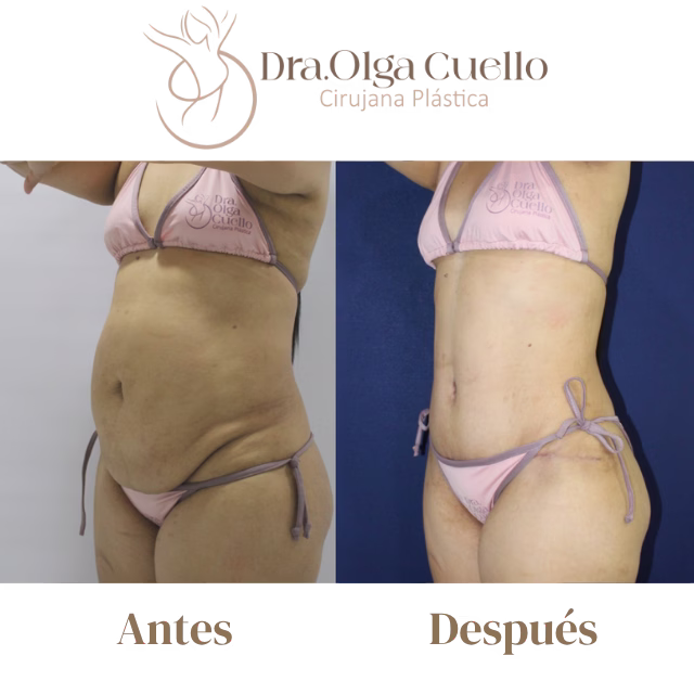 Recuperación postoperatoria de abdominoplastia — Cuidados y timeline