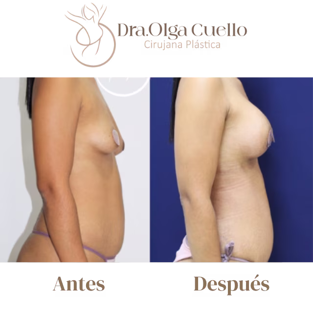 Candidatas ideales para aumento de senos — Evaluación preoperatoria