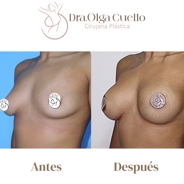 Caso real de aumento de senos en Bucaramanga con la Dra. Olga Cuello — Antes y después