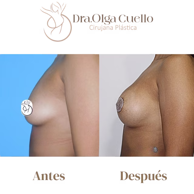 Caso real de aumento de senos en Bucaramanga con la Dra. Olga Cuello — Antes y después