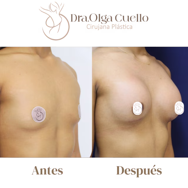 Caso real de aumento de senos en Bucaramanga con la Dra. Olga Cuello — Resultado final