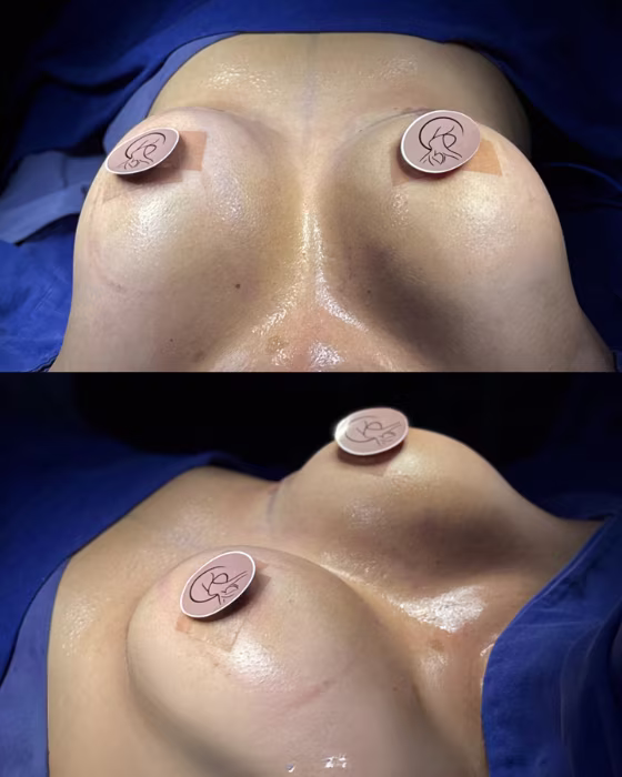 Técnica Preserve de aumento de senos — cirugía preservadora de tejidos