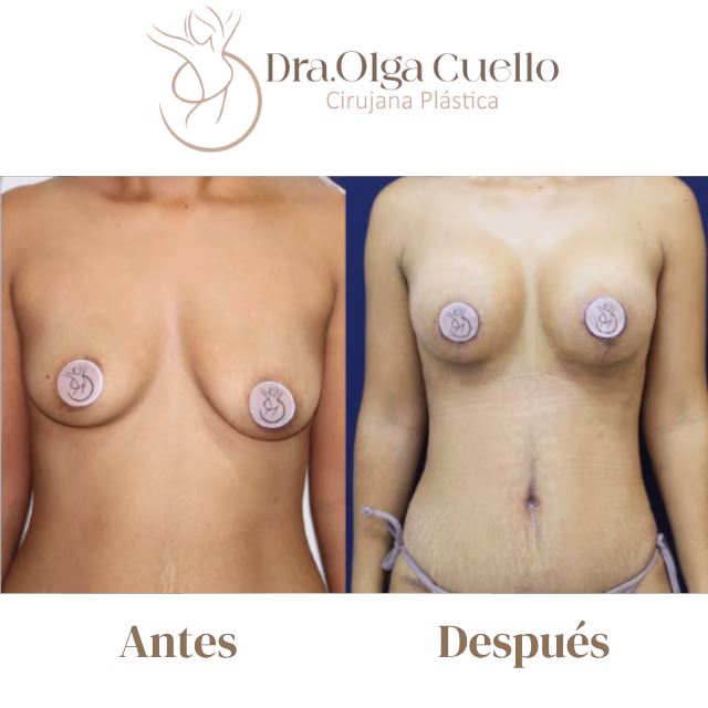 Caso real de aumento de senos en Bucaramanga con la Dra. Olga Cuello — Proceso de recuperación