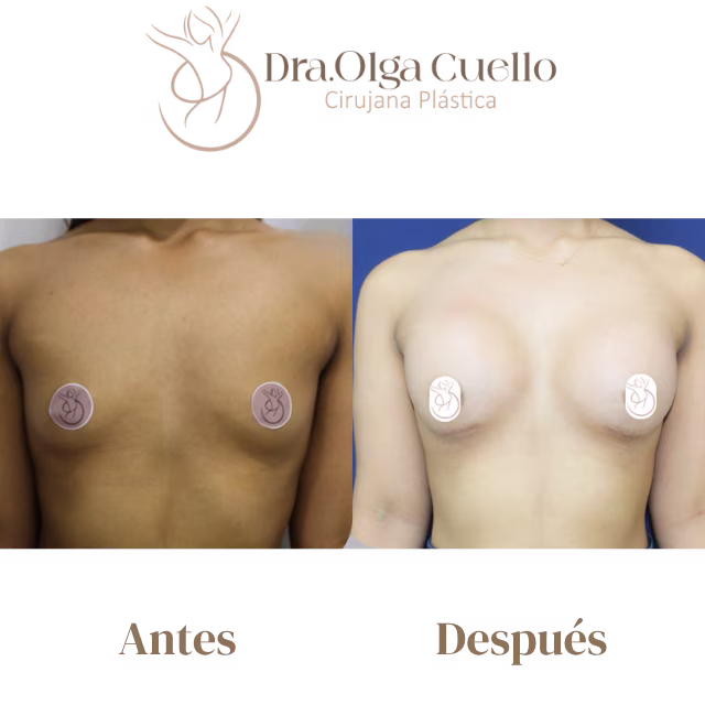 Caso real de aumento de senos en Barrancabermeja con la Dra. Olga Cuello — Antes y después