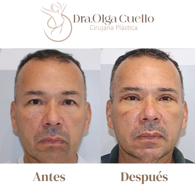 Caso real de blefaroplastia en Bucaramanga — Antes y después