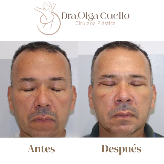Blefaroplastia en Bucaramanga — Cirugía de rejuvenecimiento de párpados
