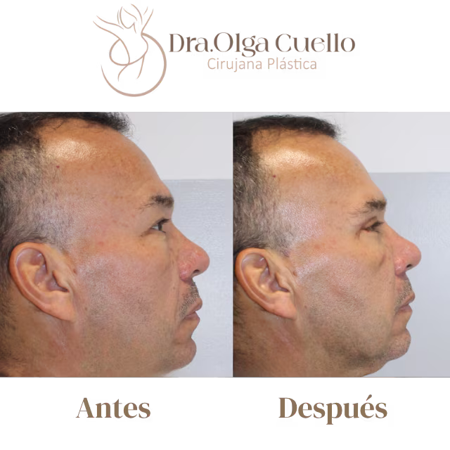 Blefaroplastia en Bucaramanga — Cirugía de rejuvenecimiento de párpados