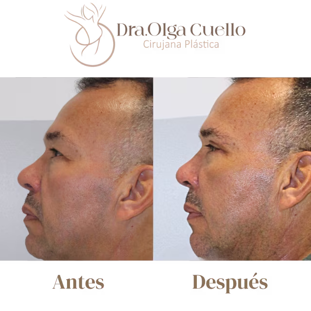 Blefaroplastia en Bucaramanga — Cirugía de rejuvenecimiento de párpados