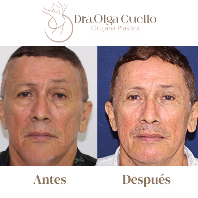 Blefaroplastia en Bucaramanga — Cirugía de rejuvenecimiento de párpados