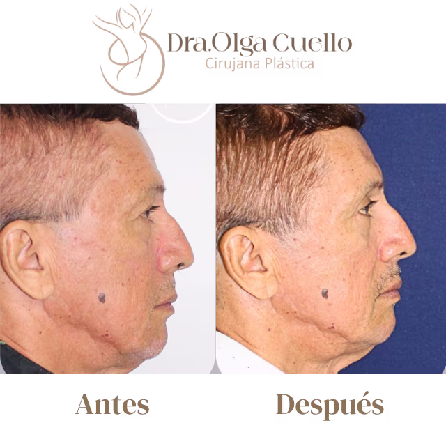 Blefaroplastia en Bucaramanga — Cirugía de rejuvenecimiento de párpados