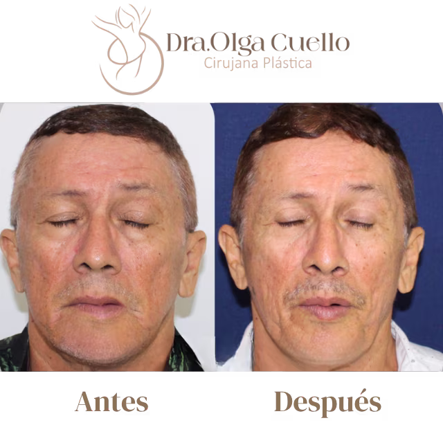 Blefaroplastia en Bucaramanga — Cirugía de rejuvenecimiento de párpados