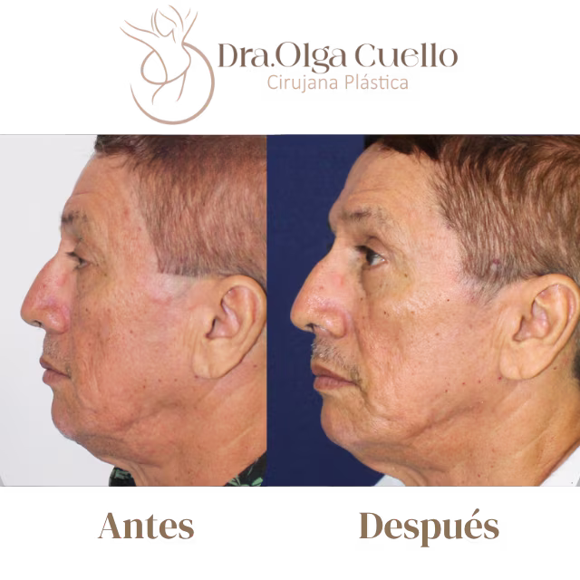 Blefaroplastia en Bucaramanga — Cirugía de rejuvenecimiento de párpados