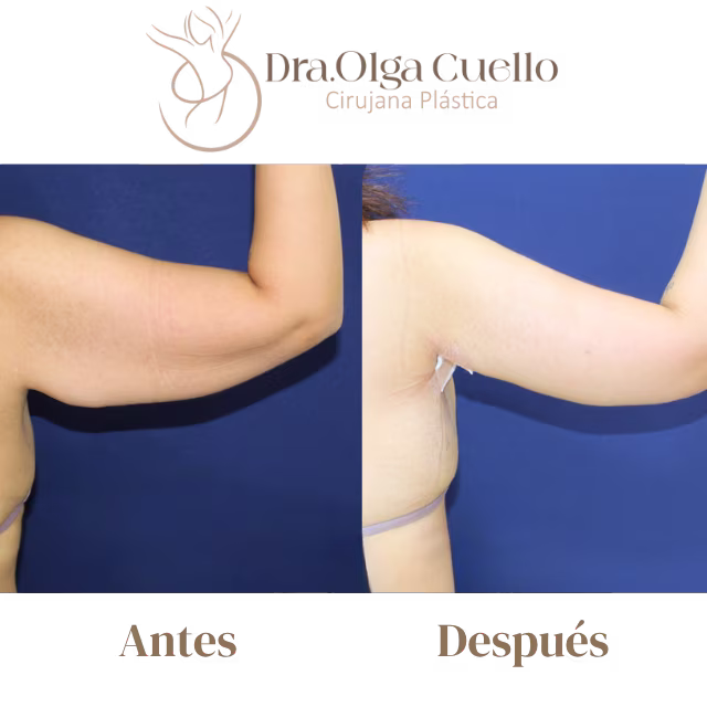 Braquioplastia antes y después — Caso de Barrancabermeja