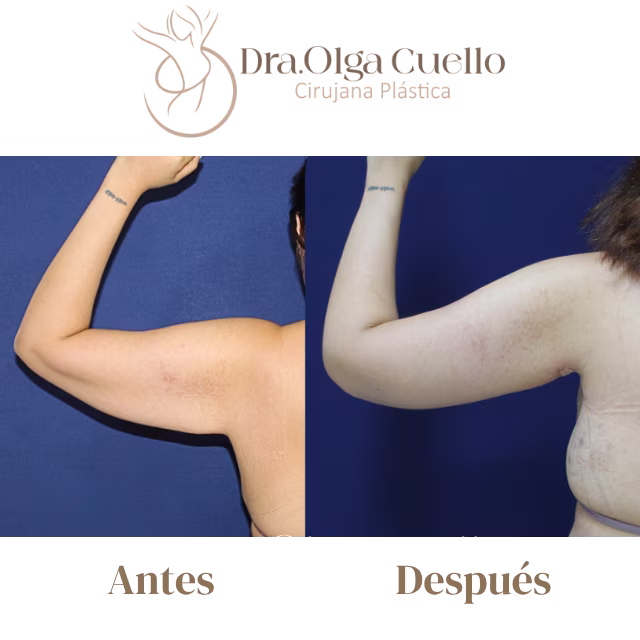 Braquioplastia antes y después — Caso de Bucaramanga