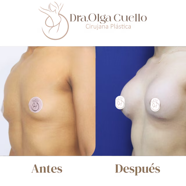 Caso real de aumento de senos en Bucaramanga con la Dra. Olga Cuello — Resultado final