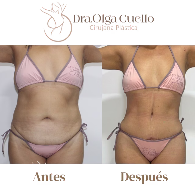Resultados de abdominoplastia en Bucaramanga — Antes y después