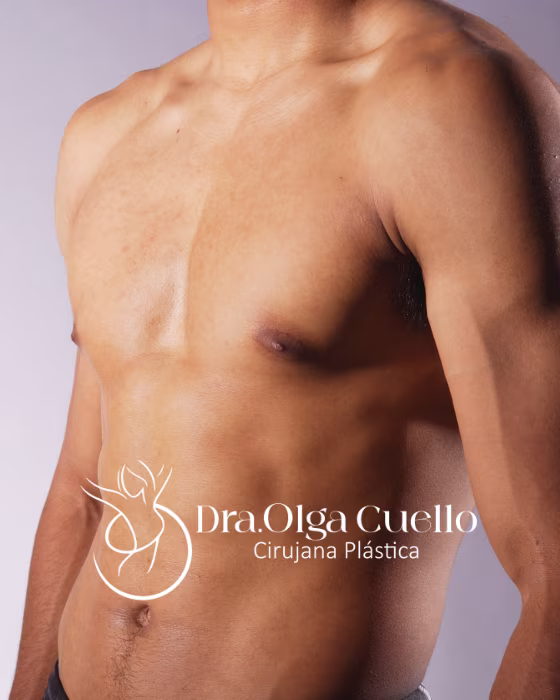 Cirugía de Ginecomastia en Bucaramanga