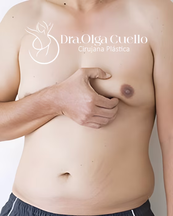 Candidatos ideales para cirugía de ginecomastia — Evaluación preoperatoria