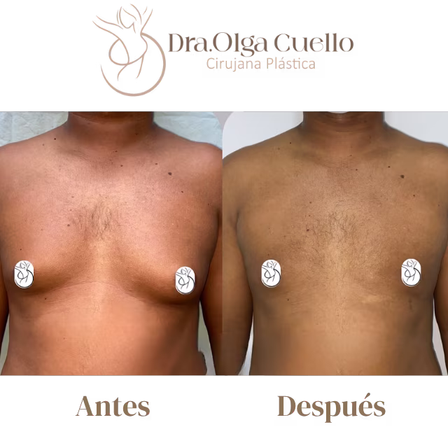 Antes y después de cirugía de ginecomastia en Bucaramanga — Contorno pectoral masculino definido