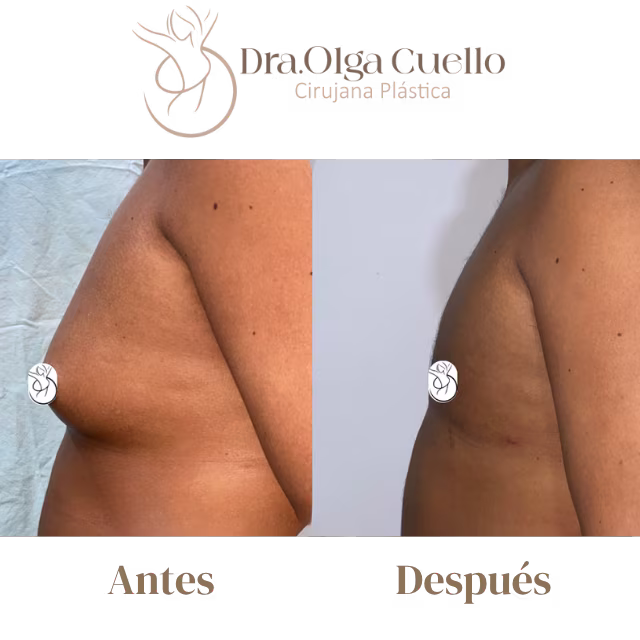 Resultados de cirugía de ginecomastia en Bucaramanga — Reducción efectiva del tejido mamario