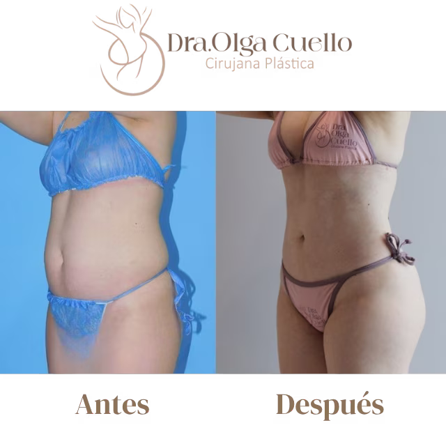 Lipoescultura de alta definición en Bucaramanga — Resultados reales con la Dra. Olga Cuello