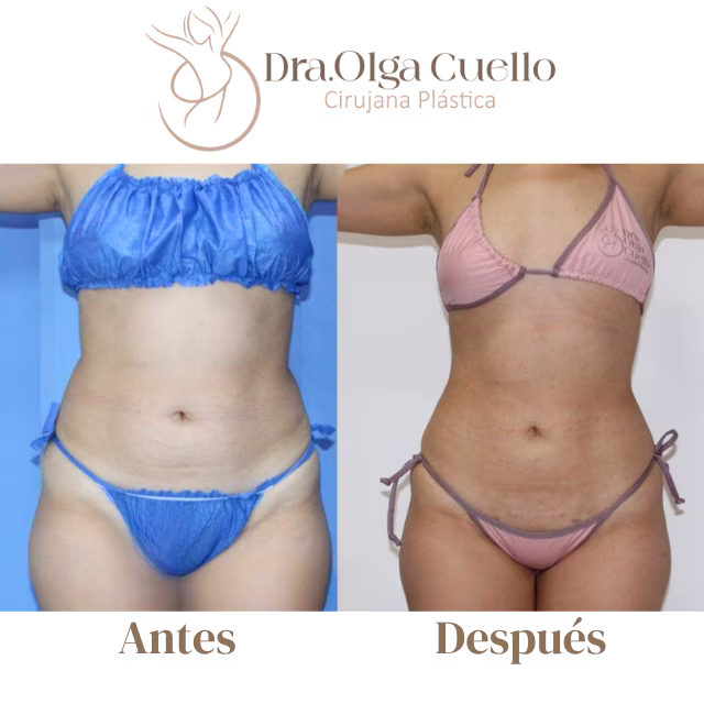 Lipoescultura de alta definición — Resultados reales con la Dra. Olga Cuello en Bucaramanga