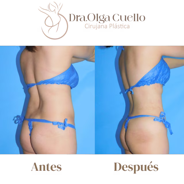Liposucción de alta definición en espalda — Resultados reales con la Dra. Olga Cuello en Bucaramanga