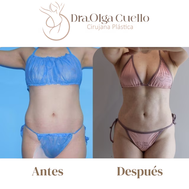 Liposucción en Bucaramanga — Resultados reales con la Dra. Olga Cuello en Bucaramanga