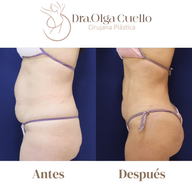 Liposucción en abdomen y flancos — Resultados reales con la Dra. Olga Cuello en Bucaramanga