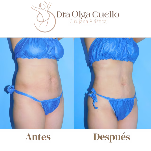 Liposucción en brazos y muslos — Resultados reales con la Dra. Olga Cuello en Bucaramanga