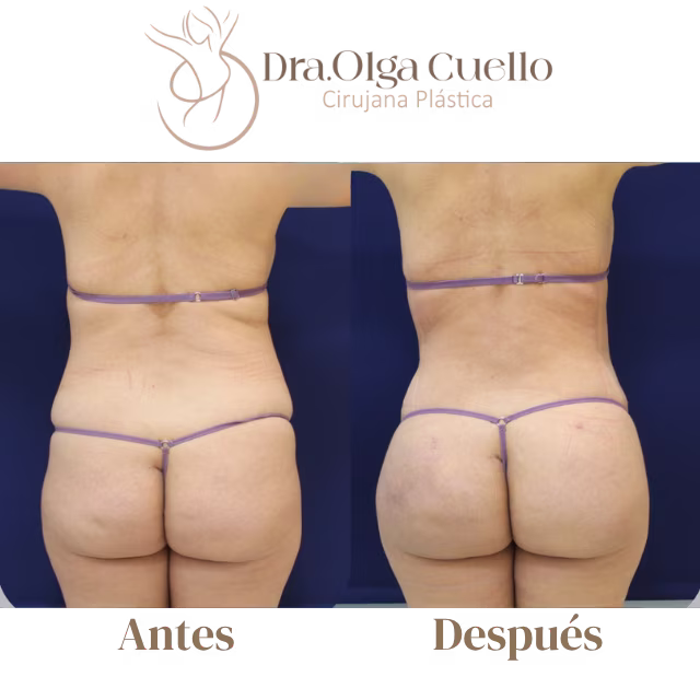 Candidatas ideales para lipotransferencia glútea — Evaluación preoperatoria