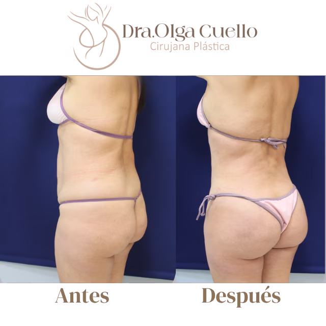 Caso real de lipotransferencia glútea con la Dra. Olga Cuello en Bucaramanga — Aumento natural de glúteos
