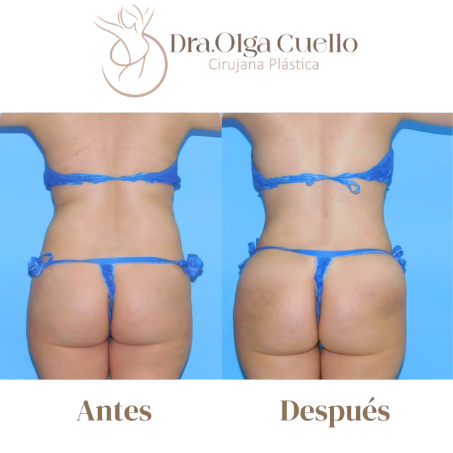 Resultados de lipotransferencia glútea con la Dra. Olga Cuello en Bucaramanga — Glúteos más voluminosos y naturales
