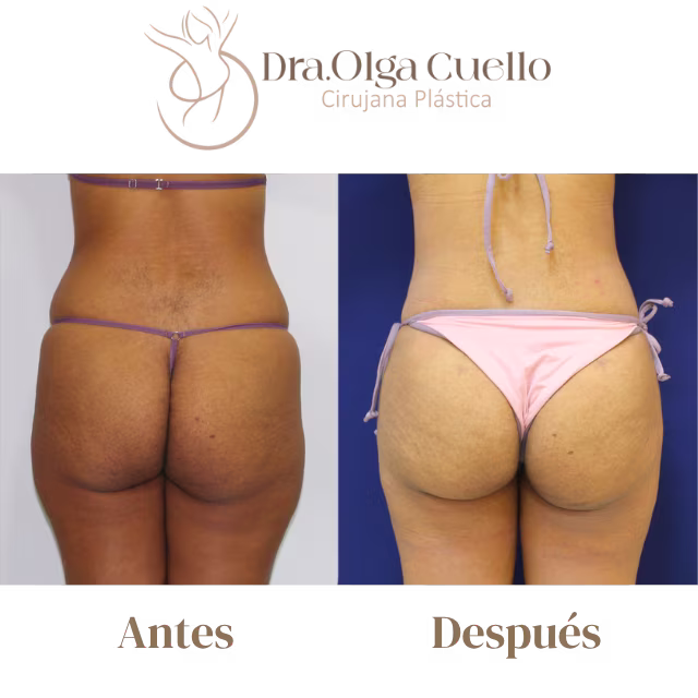 Caso exitoso de lipotransferencia glútea con la Dra. Olga Cuello en Bucaramanga — Aumento de glúteos con grasa propia