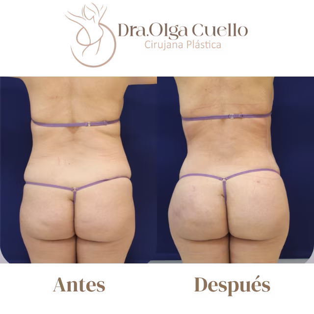 Recuperación de lipotransferencia glútea con la Dra. Olga Cuello en Bucaramanga — Proceso postoperatorio y resultados finales