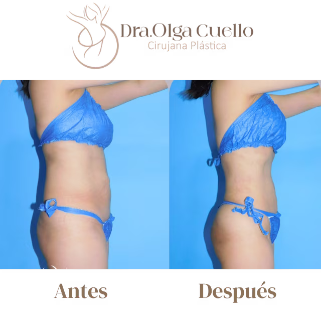 Recuperación de lipotransferencia glútea con la Dra. Olga Cuello en Bucaramanga — Proceso postoperatorio y resultados finales