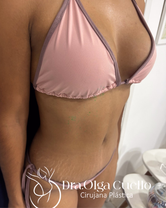 Mommy Makeover en Bucaramanga