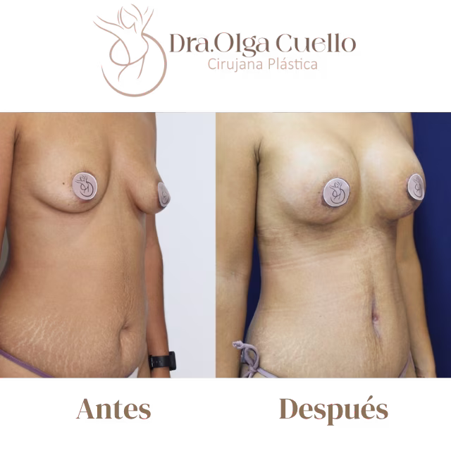 Caso real de Mommy Makeover en Bucaramanga — Transformación postparto con resultados naturales