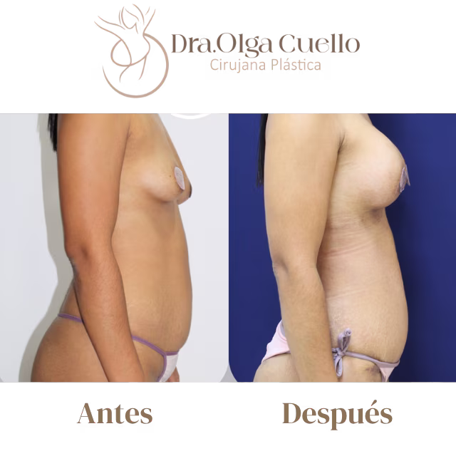 Antes y después de Mommy Makeover en Bucaramanga — Restauración de abdomen y senos después del embarazo