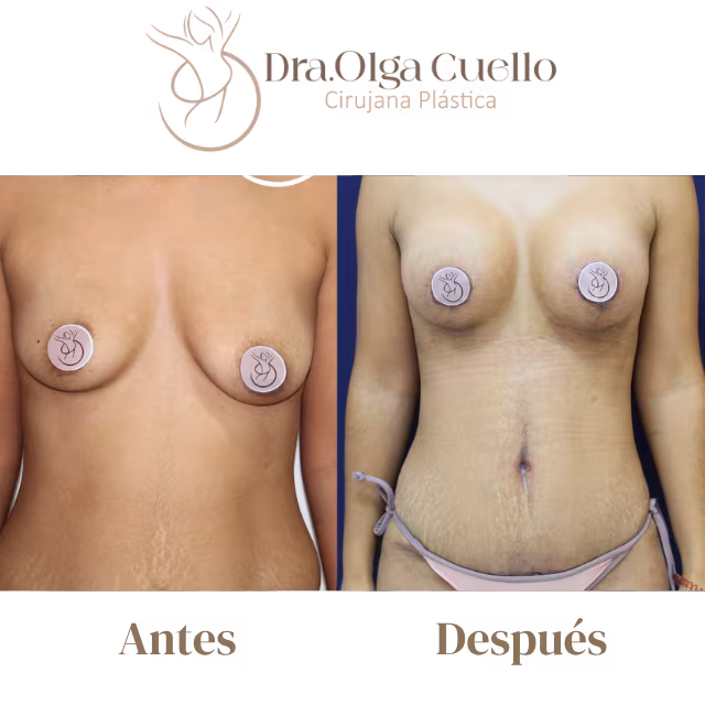 Resultados de Mommy Makeover en Bucaramanga — Contorno corporal rejuvenecido después del embarazo