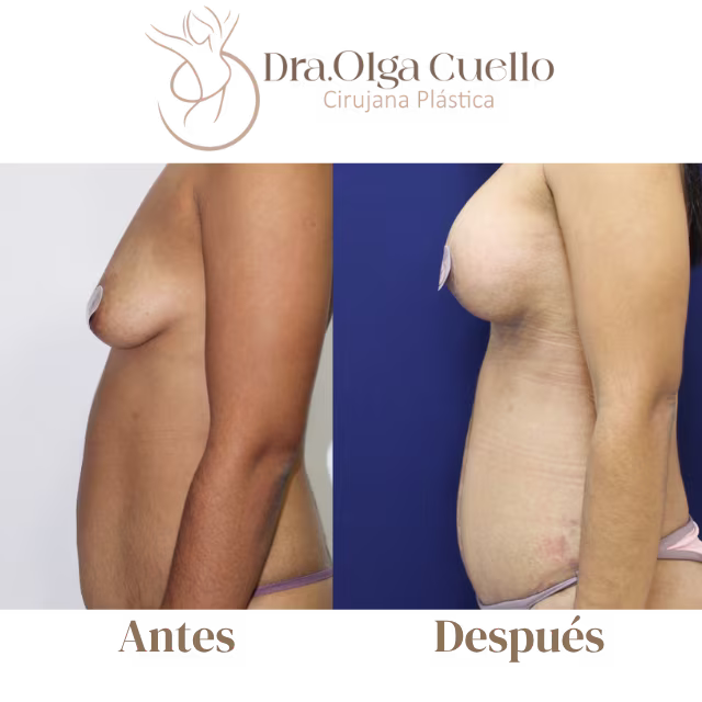 Transformación de Mommy Makeover en Bucaramanga — Abdomen plano y senos firmes después del embarazo
