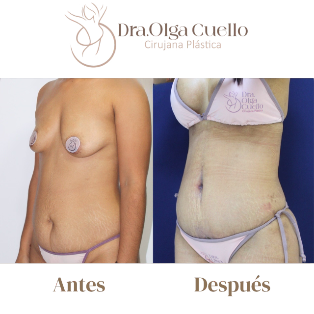 Mommy Makeover en Bucaramanga — Restauración corporal postparto