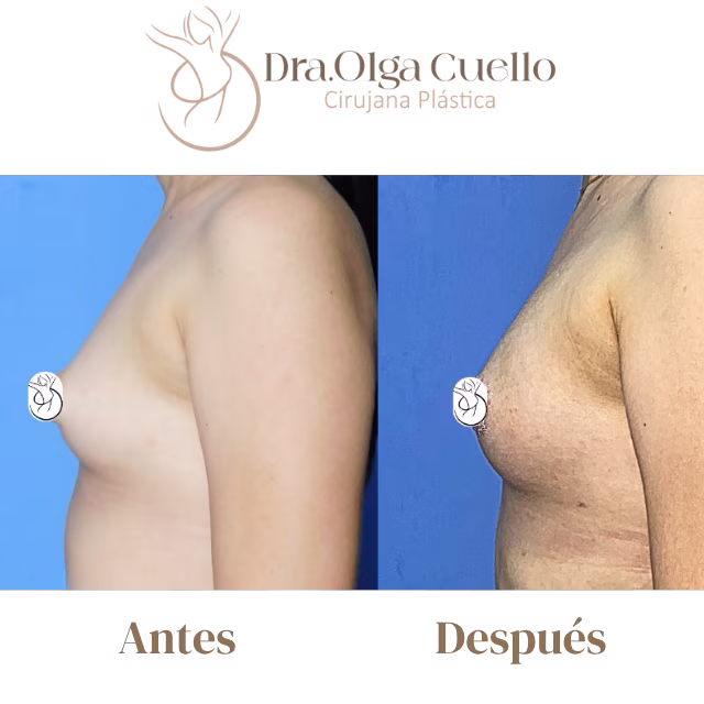 Pacientes reales de aumento de senos en Bucaramanga con la Dra. Olga Cuello — Resultados naturales