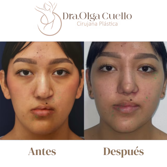 Recuperación postoperatoria de rinoplastia — Evolución de la inflamación nasal