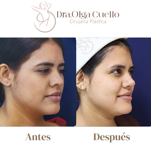 Proceso paso a paso de rinoplastia — Cirugía de remodelación nasal en Bucaramanga