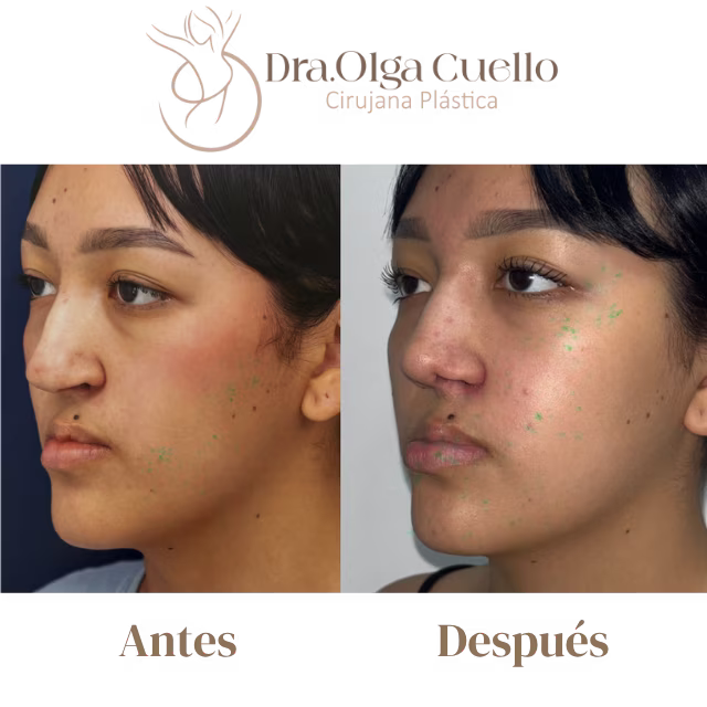 Paciente en recuperación de rinoplastia — Proceso de cicatrización nasal