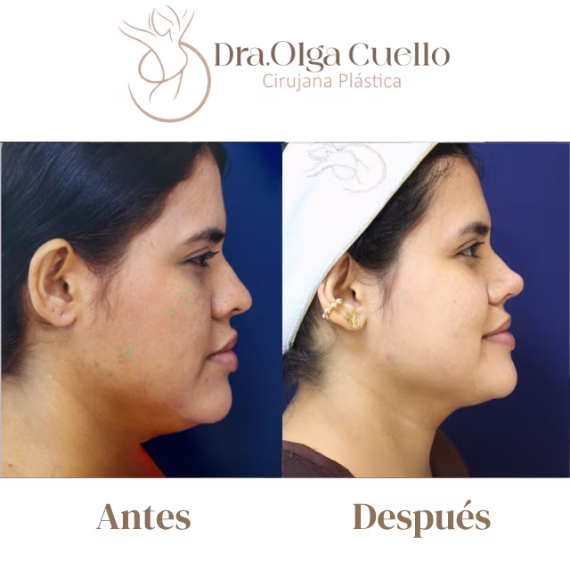 Resultado final de rinoplastia — Nariz armónica y natural