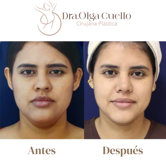 Rinoplastia estética en Bucaramanga — Procedimiento de remodelación nasal